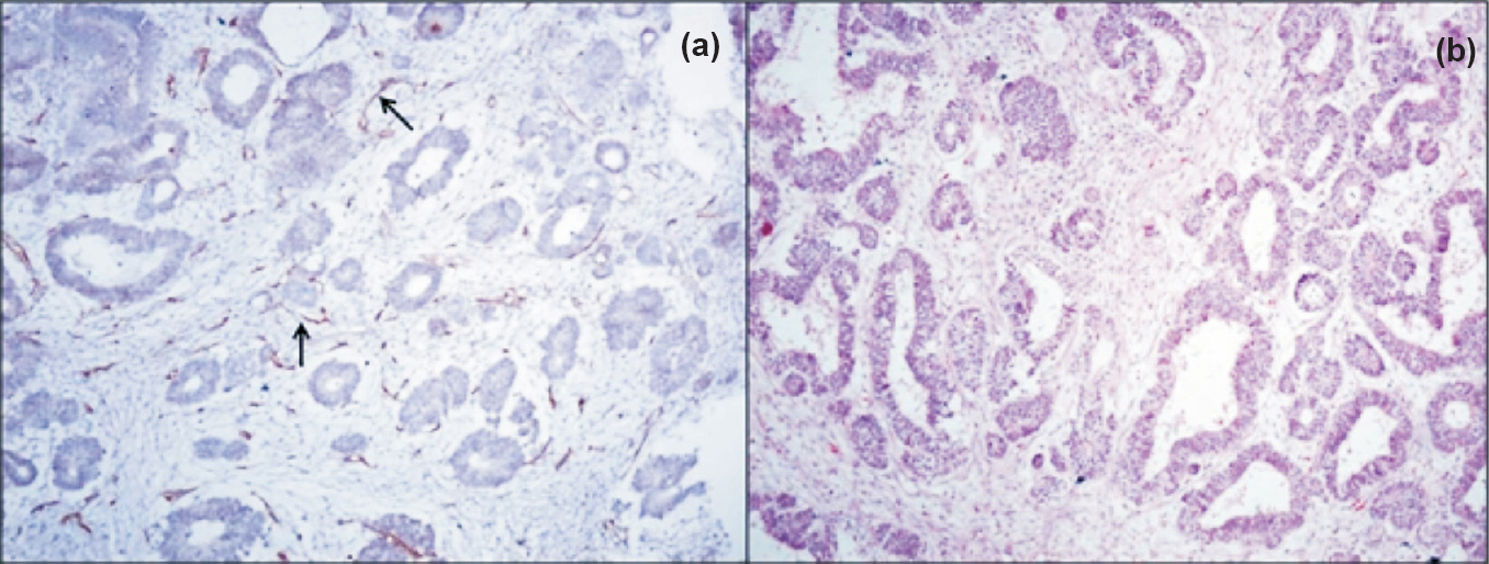(a). WT1 immunostaining can highlight scant heterologous stromal components (arrows) (Immunostain x100), (b) which otherwise may not be apparent on routine Hematoxylin & Eosin stain (H&Ex100).